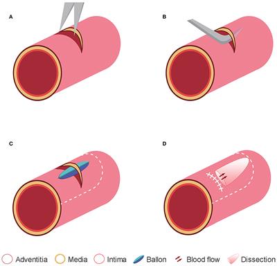 Establishment of Carotid Artery Dissection and MRI Findings in a Swine Model